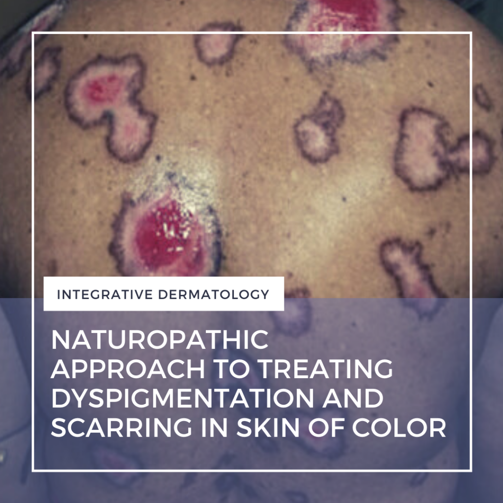 Naturopathic Approach To Treating Dyspigmentation And Scarring In Skin