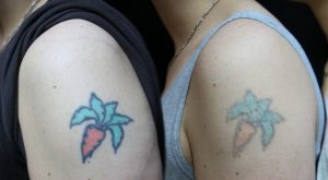 Tattoo Removal Consent