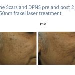fractional laser photo