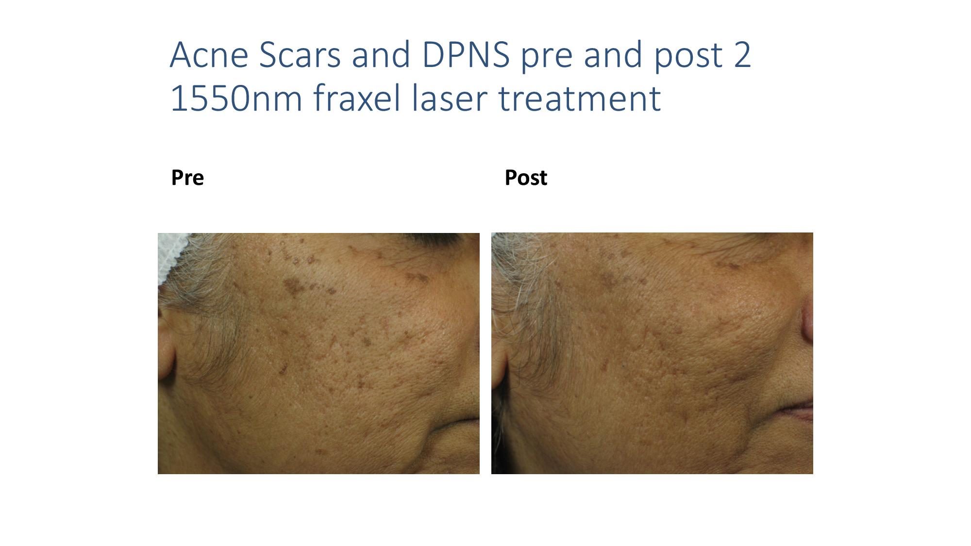 fractional laser photo