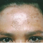 Pop Quiz Melasma
