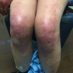 Violaceous Erythema