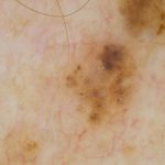 Neoplasms_Pigmented-BCC