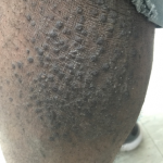 chronic pruritic eruption