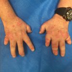 Next Steps Mucosal Candidal Infections