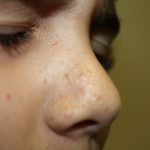 Facial Papules
