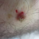 Hand Biopsy koilocytes