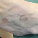 Granuloma Annulare