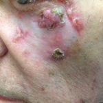 cutaneous neoplasm