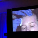 Chemical Peels