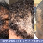 hair disorders