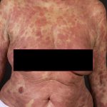 Cutaneous T-cell lymphoma