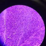 Nodule Biopsy