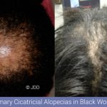 Alopecia