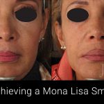 Happy Face treatment