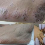 Dermatophytosis