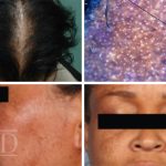 hyperpigmentation