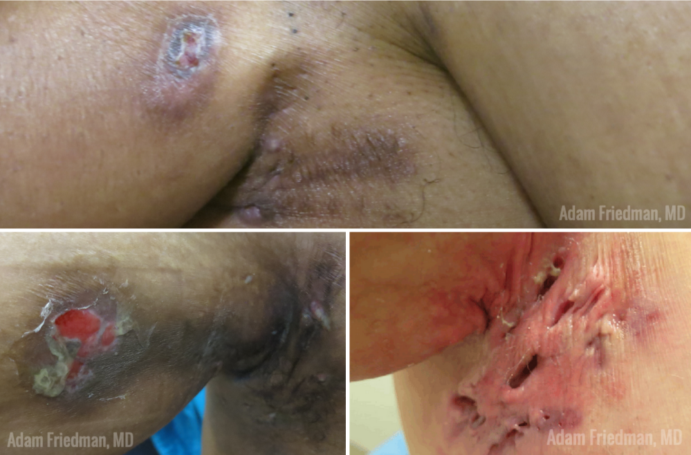 hidradenitis suppurativa