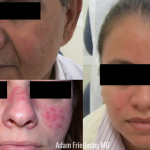 rosacea
