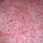 Psoriasis