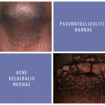 skin of color
