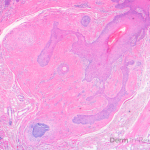 papules pathology