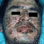 gout