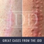 Botox for scar pain