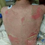 epidermal detachment