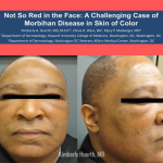Morbihan Disease
