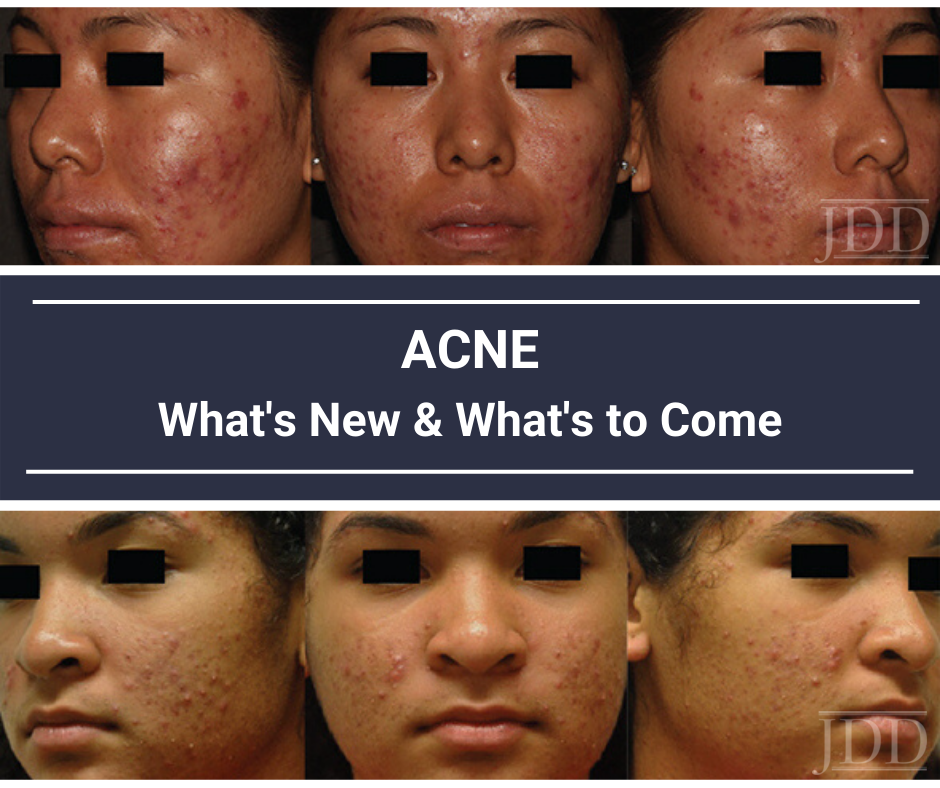 Acne in Skin of Color