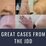 Porokeratosis With Ablative Fractional Carbon Dioxide Laser