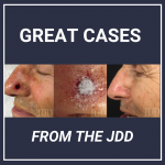 Methacrylate Polymer Powder Dressing for a Nasal Surgical Defect