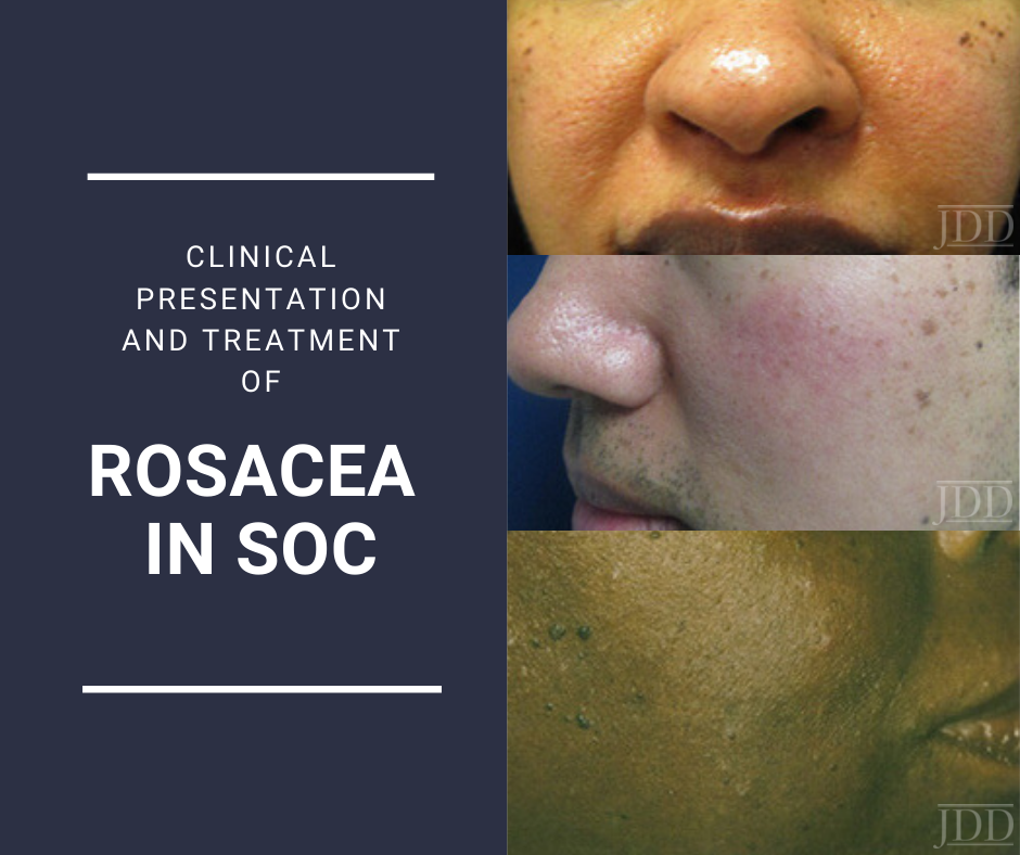 Rosacea in SOC