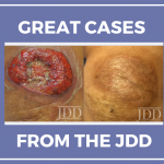Pyoderma Gangrenosum Patient