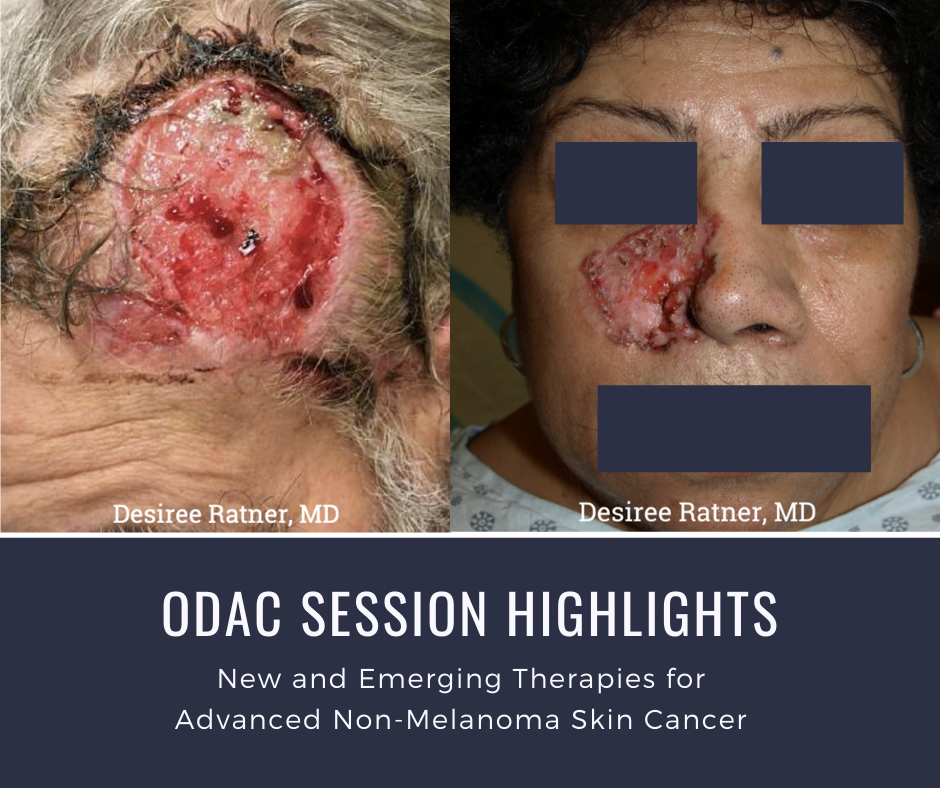 Advanced Non-Melanoma Skin Cancer