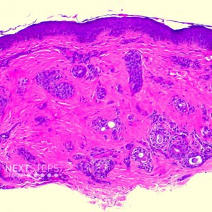 neoplasm