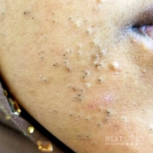 comedonal acne