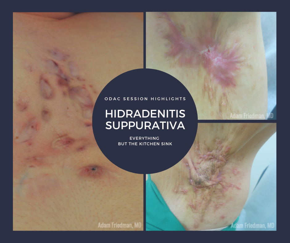 Hidradenitis Suppurativa