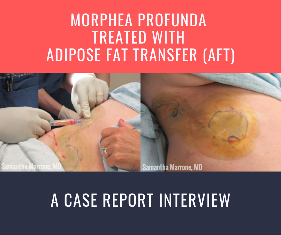 Morphea Profunda Treated with Adipose Fat Transfer (AFT)