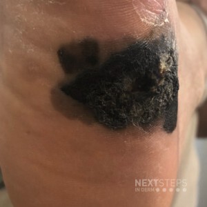 melanoma