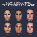 Acne Treatments