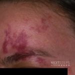 laser treatment
