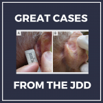 Invasive Invasive Cutaneous Squamous Cell Carcinoma