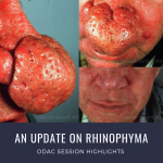rhinophyma
