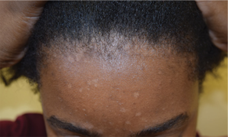 seborrheic dermatitis of the face and scalp