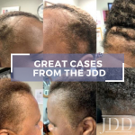 Hair Loss in African American Woman