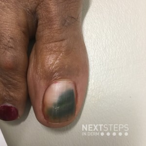 green nail syndrome