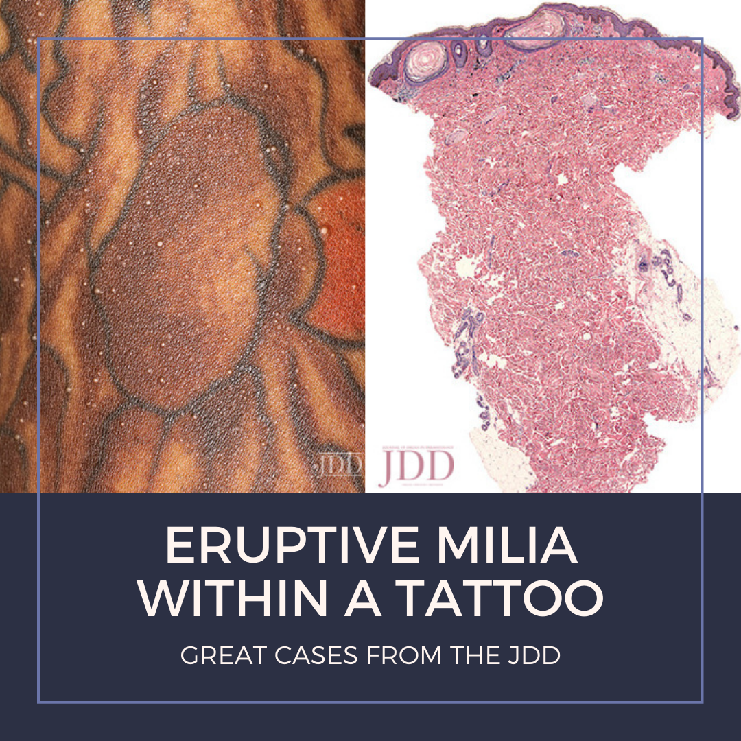 Milia within a tattoo