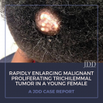 Trichilemmal Tumor